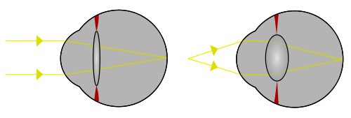 Gleitsichtgläser - Augenlinse