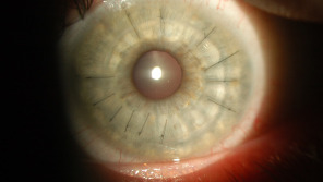 Keratoplastik: Versorgung bei Hornhautverletzungen