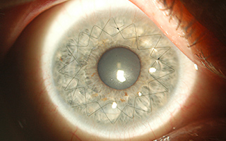 Keratoplastik